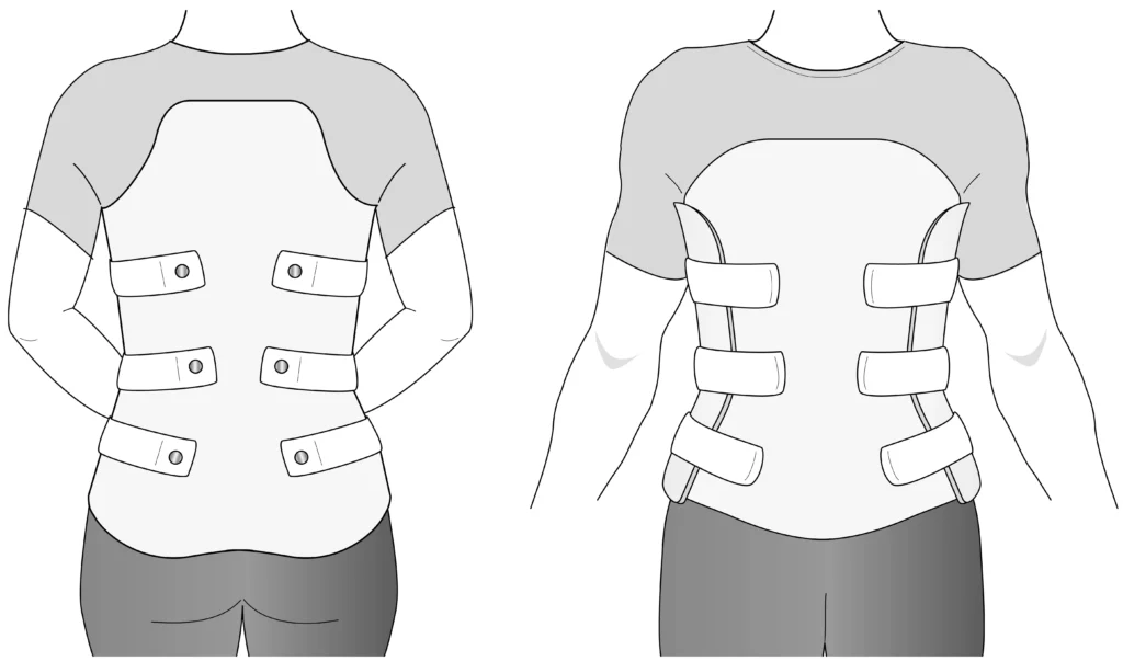 Image of a TLSO back brace for a broken back bone