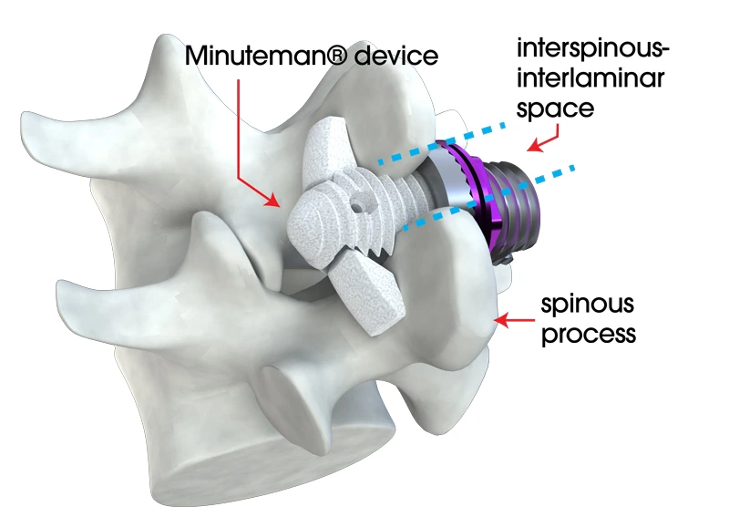 Graphic of a Minuteman implant deployed between two vertebrae with the image labelled with the implant and relevant anatomy