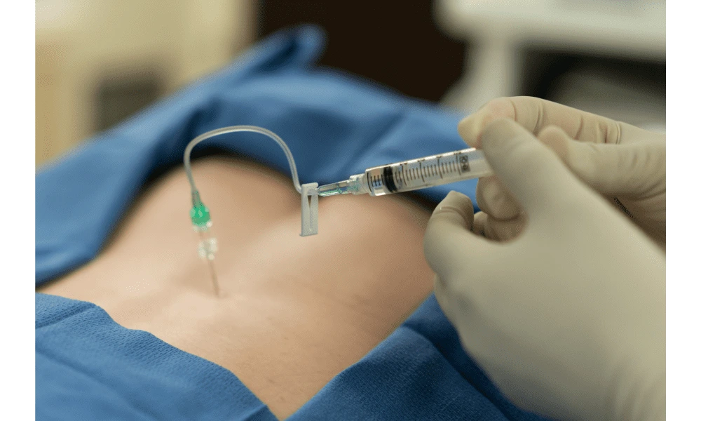 Picture of contrast being injected into a needle in the epidural space