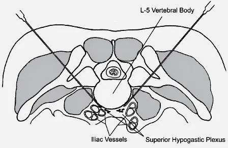 Graphic showing needle placement for hypogastric nerve block