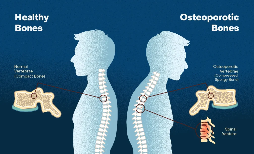 IMage showing the difference between healthy compact vertebral bone, and osteoporotic spongy and fragile bone. 