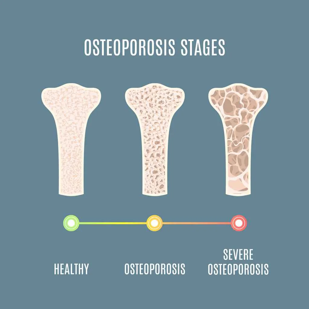 Image showing the stages of bone health from strong, compact, healthy bone, to the weak and compressed spongy bone of osteoporosis, to finally the brittle hollowed out bone of severe osteoporosis