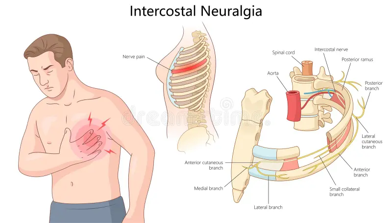 Illustration of a man gripping his chest from intercostal neuralgia. The illustration includes a cutaway diagram of the anatomy of the intercostal nerve