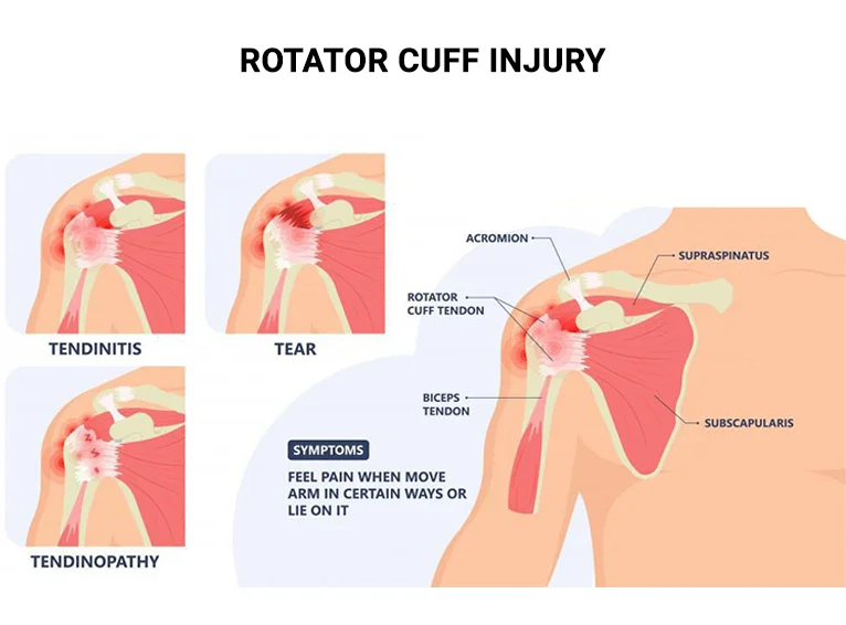 Image demonstrating the different causes of rotator cuff pain. Demonstrates tendinitis, tendinopathy, and rotator cuff tears