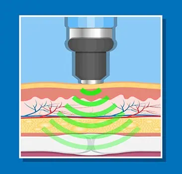 Extracorporeal shock waves entering and spreading into the deep tissue