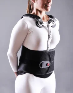 Image of a woman wearing a TLSO back brace with an anterior stabilization rod connecting the lower portion to the upper portion overlying the sternum