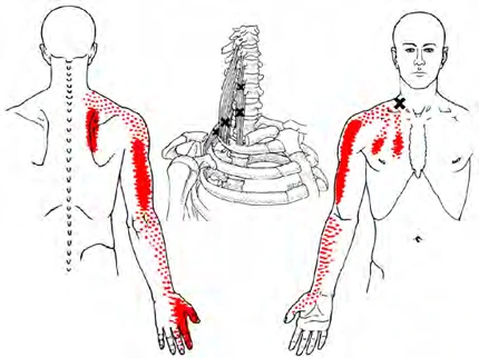 Diagram mapping the trigger-point referral patterns for trigger-point injections in the scalene muscle