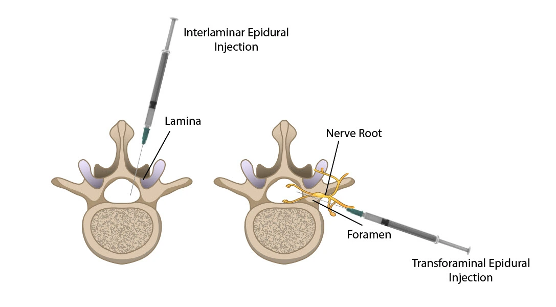 Image showing the difference between the interlaminar and transforaminal approaches to the epidural space