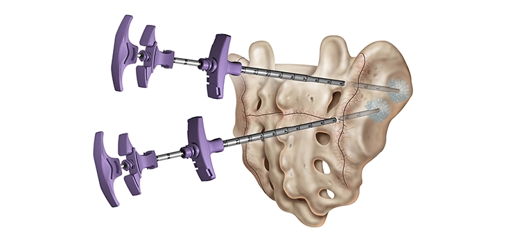 Illustration demonstrating the placement of two trocars in the lateral aspect of the a sacrum for placement of bone cement