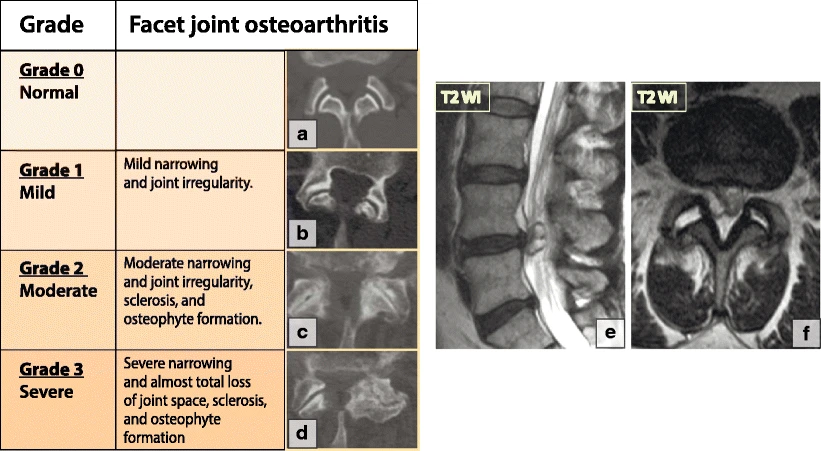 Image depicting the various stages of facet joint degeneration