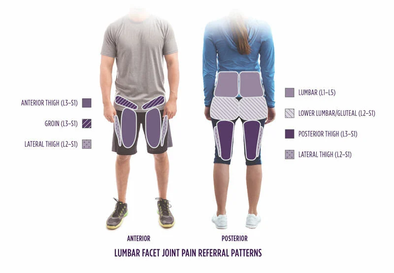 Image depicting the referral patterns of the different lumbar facet joints