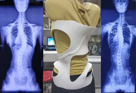 Image depicting a custom scoliosis TLSO brace specially designed to correct scoliosis as demonstrated by accompanying x-ray images