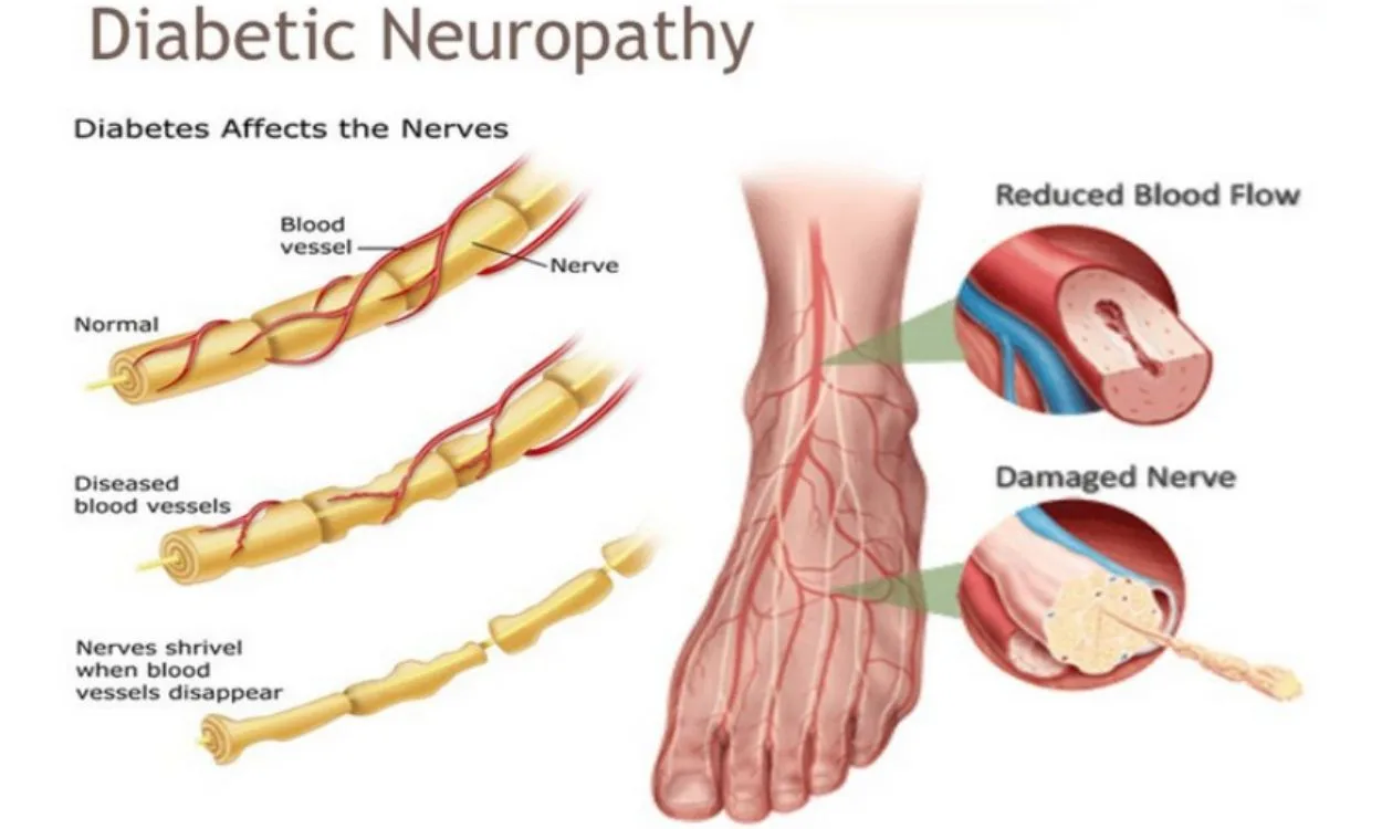 Illustration of nerve damage caused by diabetic peripheral neuropathy