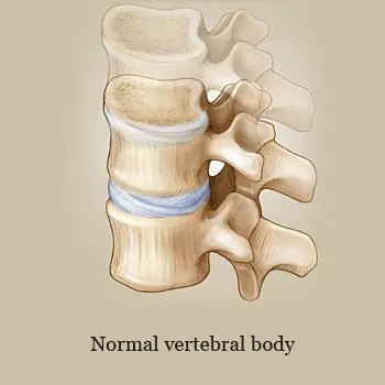 Medical illustration of kyphoplasty in Laveen to repair vertebral compression fractures