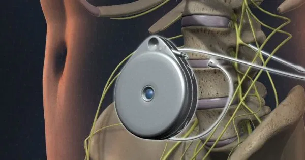 Intrathecal drug delivery system for targeted cancer pain relief