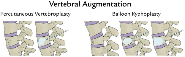 Medical diagram comparing kyphoplasty and vertebroplasty procedures used to treat spine fractures in Ahwatukee.