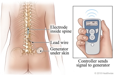 Diagram showing spinal cord stimulator placement for treating diabetic neuropathy