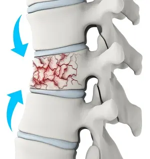 Illustration of vertebral compression fracture commonly treated with kyphoplasty vertebroplasty in Ahwatukee patients.