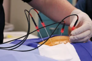Doctor performing radiofrequency ablation to treat facet joint arthritis in the thoracic spine