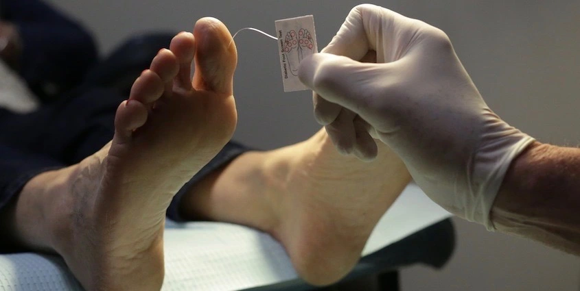 Healthcare professional performing monofilament test on diabetic foot