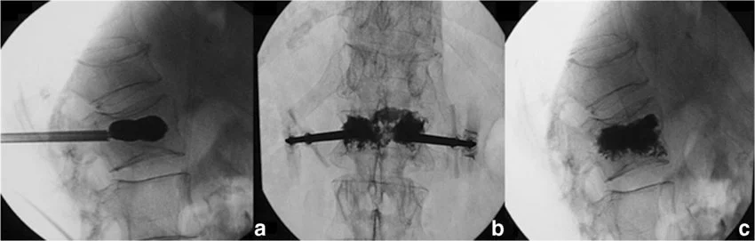 Kyphoplasty image showing balloon-assisted vertebral compression fracture treatment under fluoroscopy