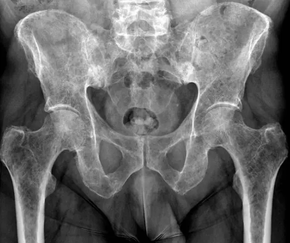 Imaging demonstrating multiple myeloma lesions of the pelvis and femur