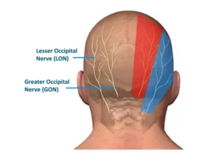 Medical diagram showing occipital nerve pathways that cause back of head and neck pain
