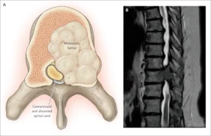 Metastatic cancer in thoracic spine causing middle back bone pain