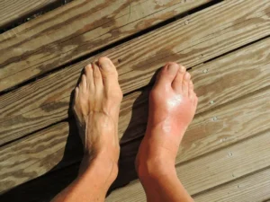 Complex regional pain syndrome right foot