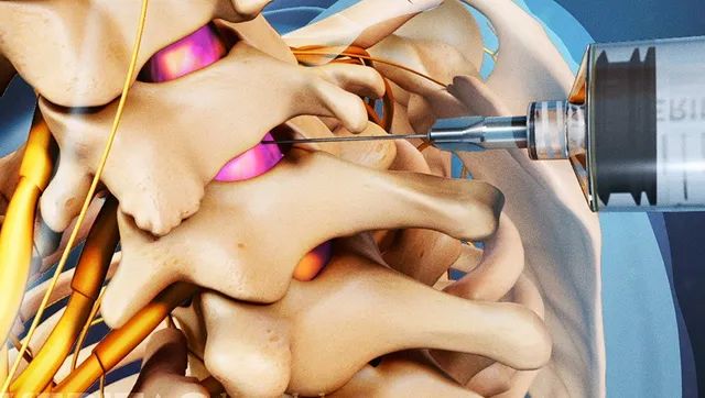 Graphic demonstrating a needle entering the cervical epidural space