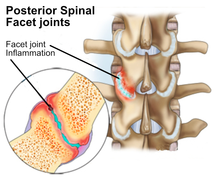 Graphic depicting facet arthropathy