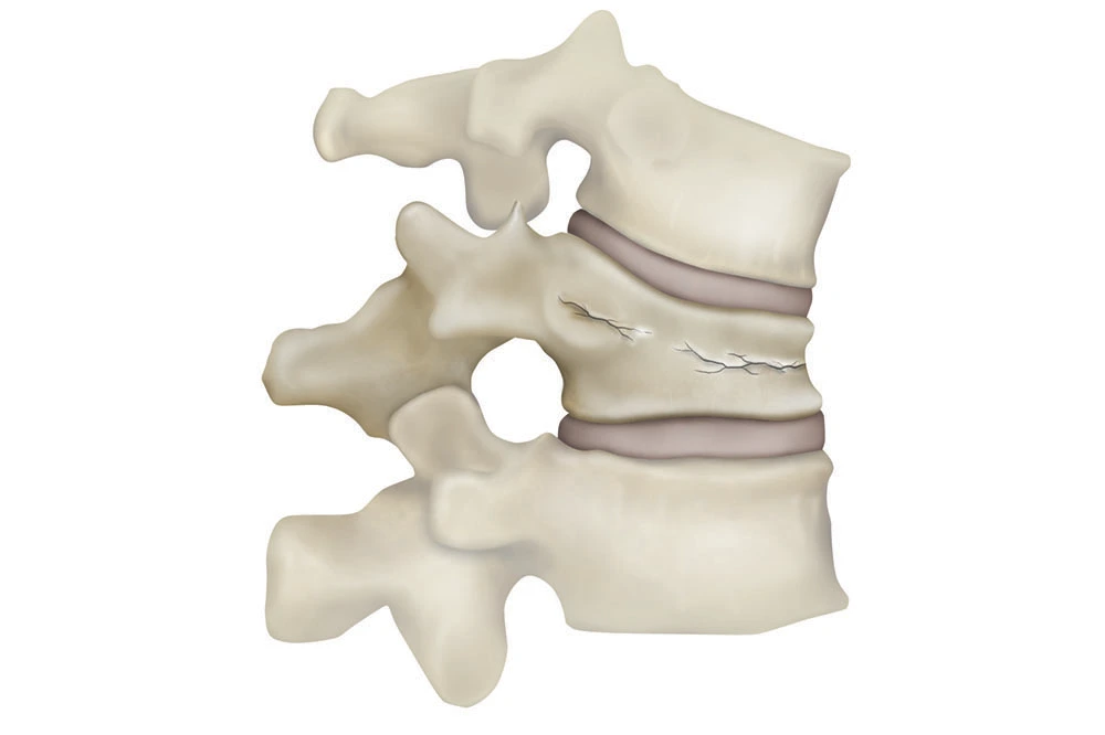 Image of a broken back bone between two healthy vertebrae