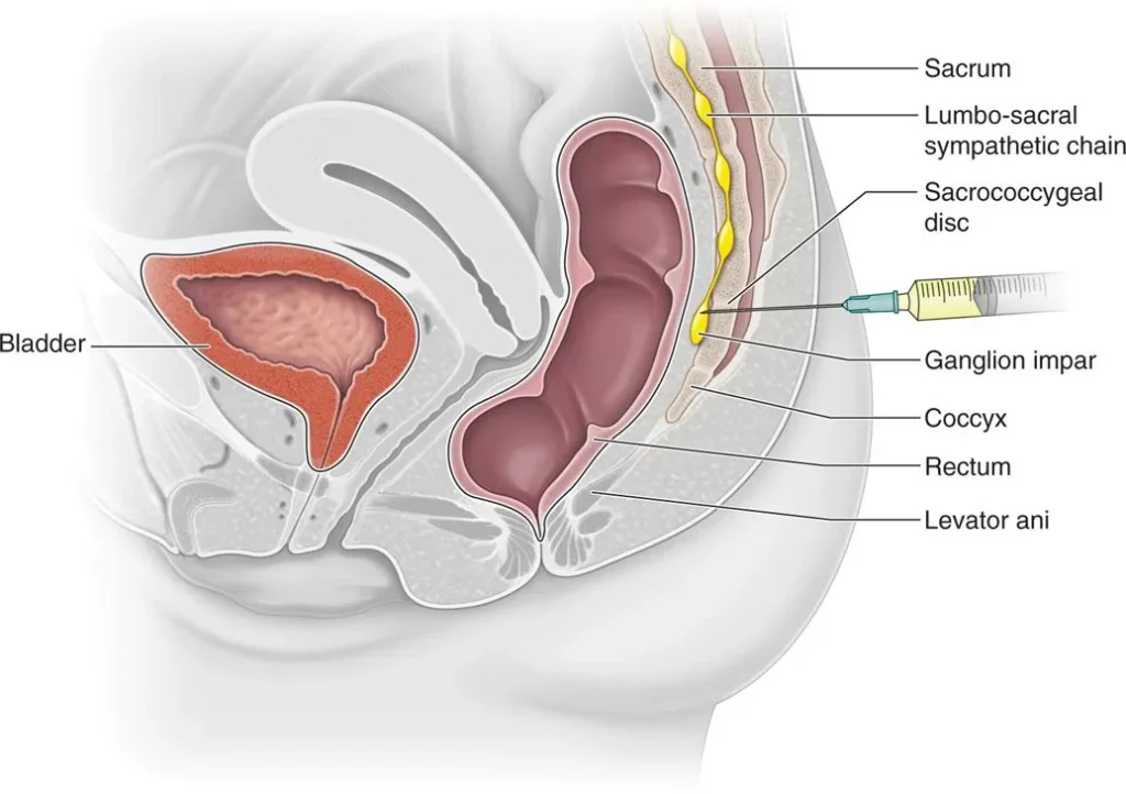 Cutaway Anatomy illustration demonstrating Ganglion of Impar injection