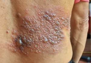 shingle pain rash